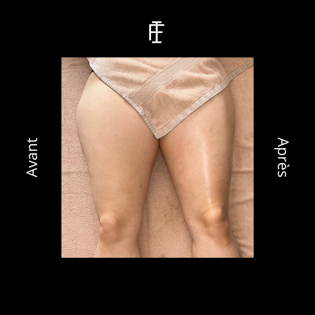 Avant après drainage – cuisses affinées
